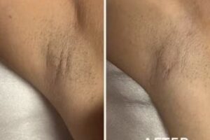 Laser and Body contour