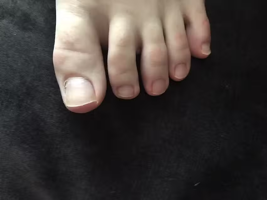 tiptoe – specialist in schimmelnagels en kalknagels – Capelle aan den IJssel